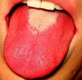 scarlatine-symptomes-langue